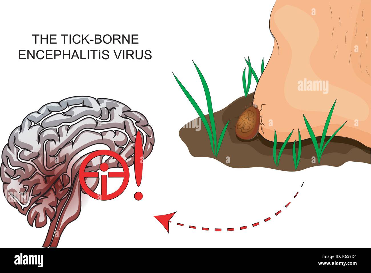 illustration of a tick encephalitis and inflammation of the brain Stock Vector