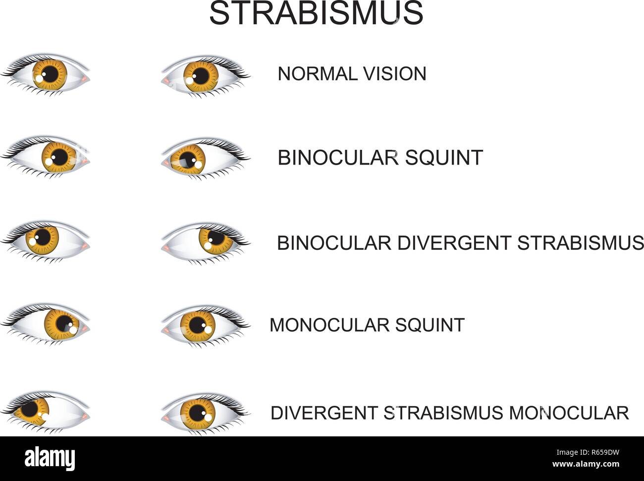 Strabismus hi-res stock photography and images - Alamy