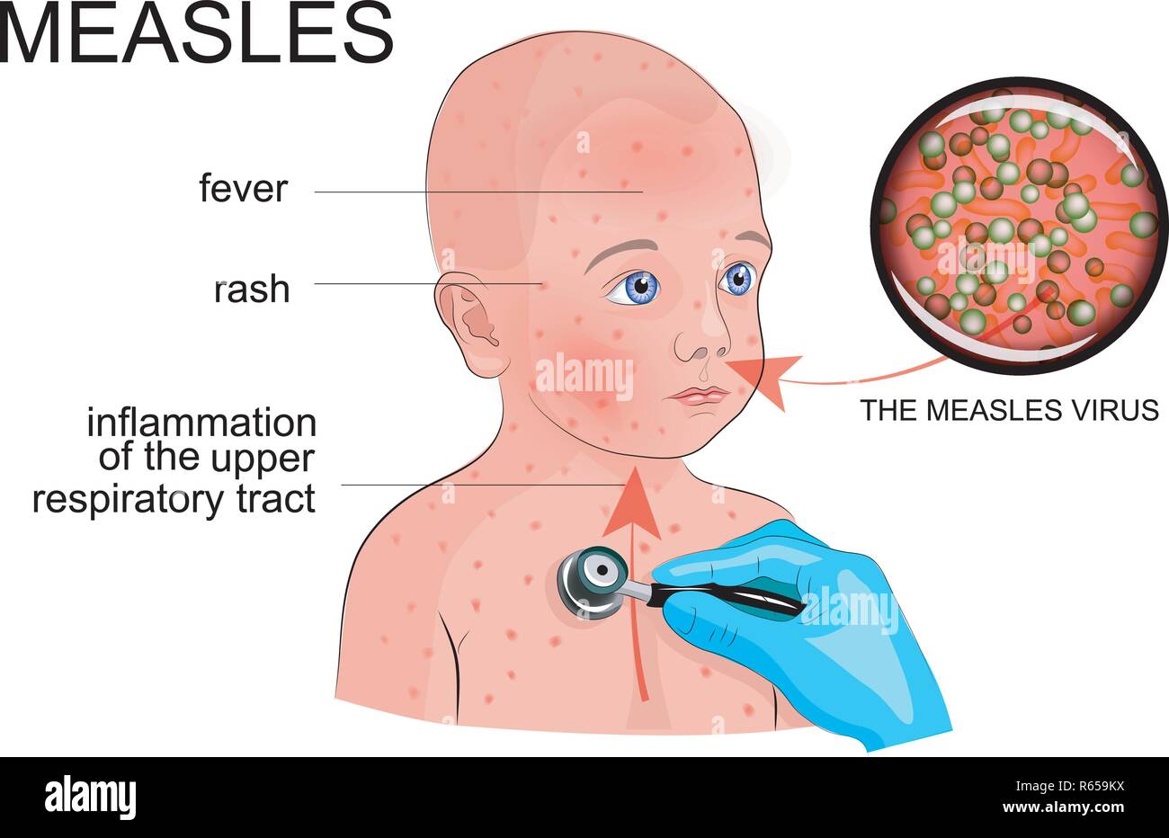 illustration of a boy with symptoms of rubella or measles Stock Vector