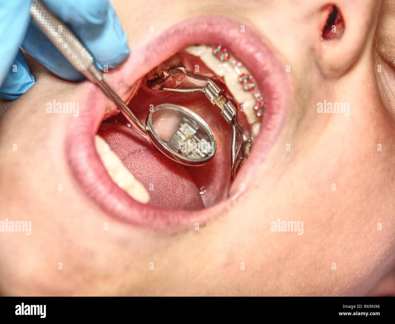 Prague, Czech Republic September 28th 2018. The Hyrax (Hygienic Rapid Expander) Banded designed as an upper arch rapid palatal expanding appliance. Stock Photo