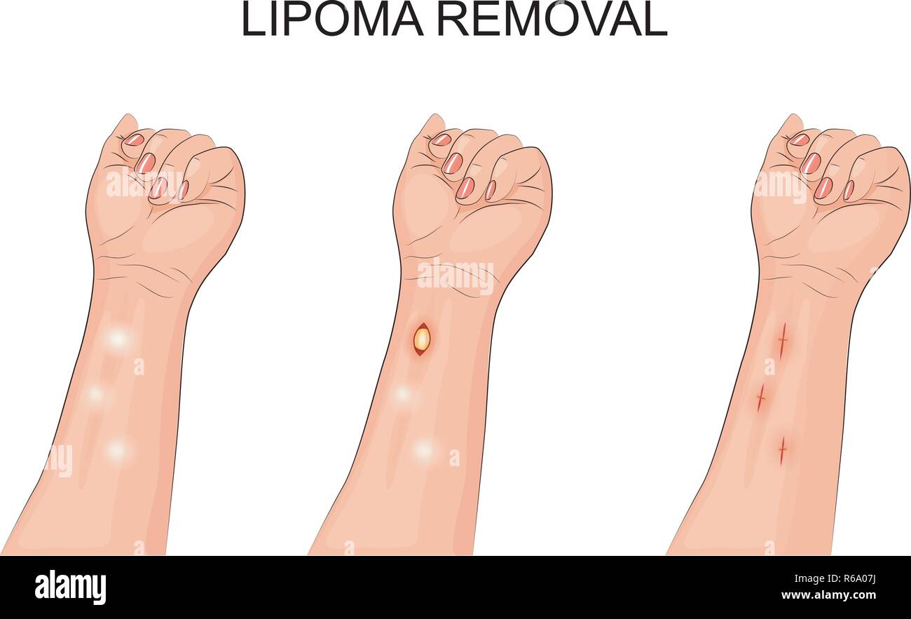 illustration of a lipoma. removal of lipoma on forearm Stock Vector