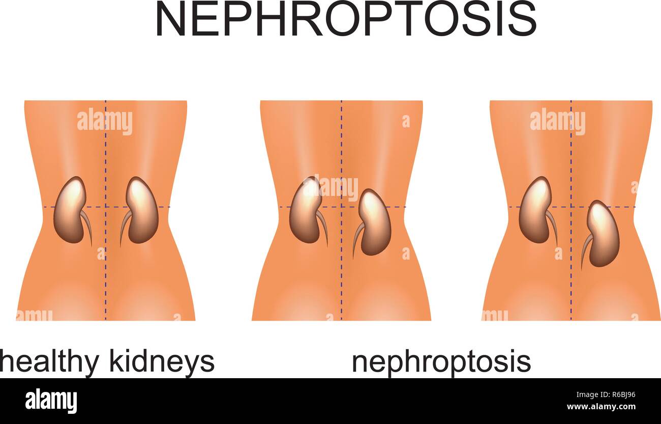 illustration of the omission of the kidneys with different degree of complexity Stock Vector