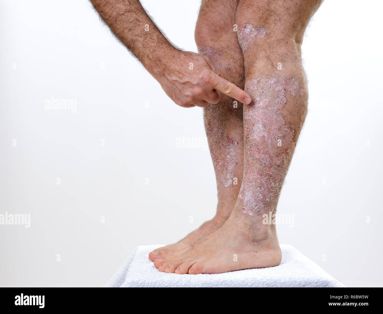 Scaly skin human hi-res stock photography and images - Alamy