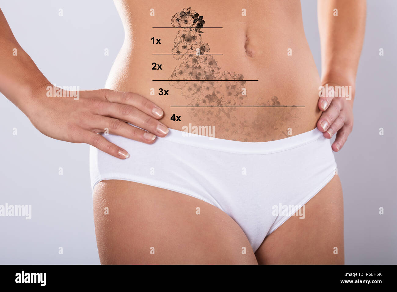 Closeup Of Woman Stomach Showing Before And After Laser Tattoo Removal  Treatment Stock Photo Picture And Royalty Free Image Image 66442846