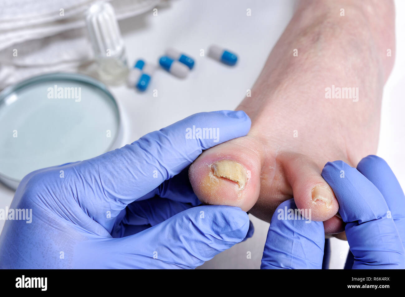 Onychomycosis medication hires stock photography and images Alamy