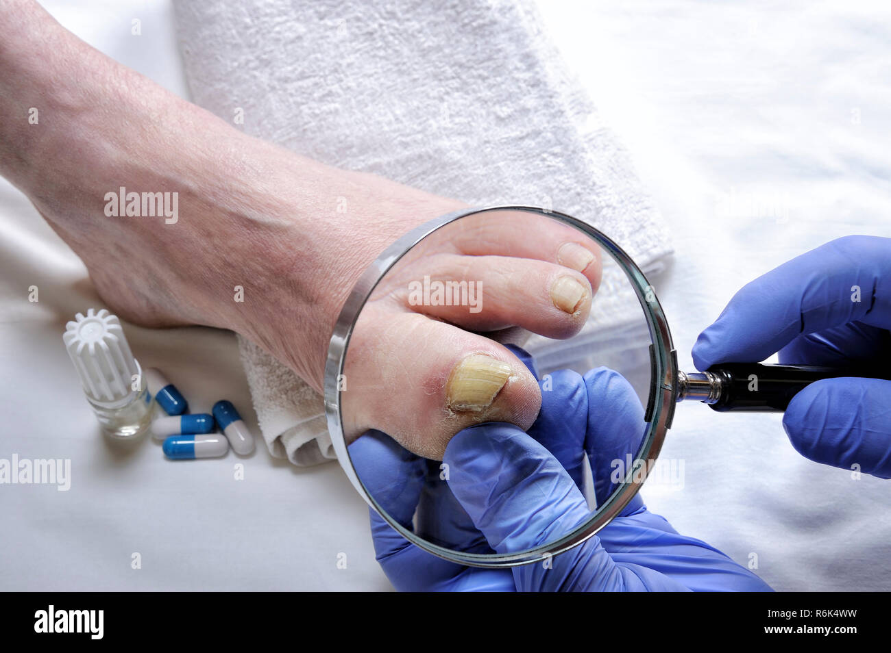 Onychomycosis medication hires stock photography and images Alamy
