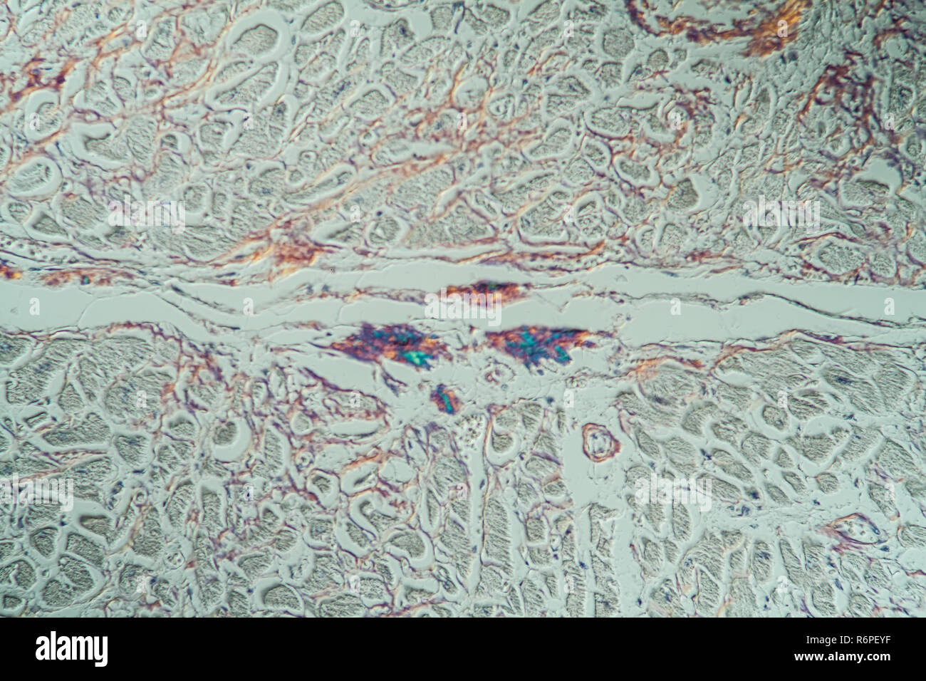 amyloid deposits in the heart Stock Photo Alamy