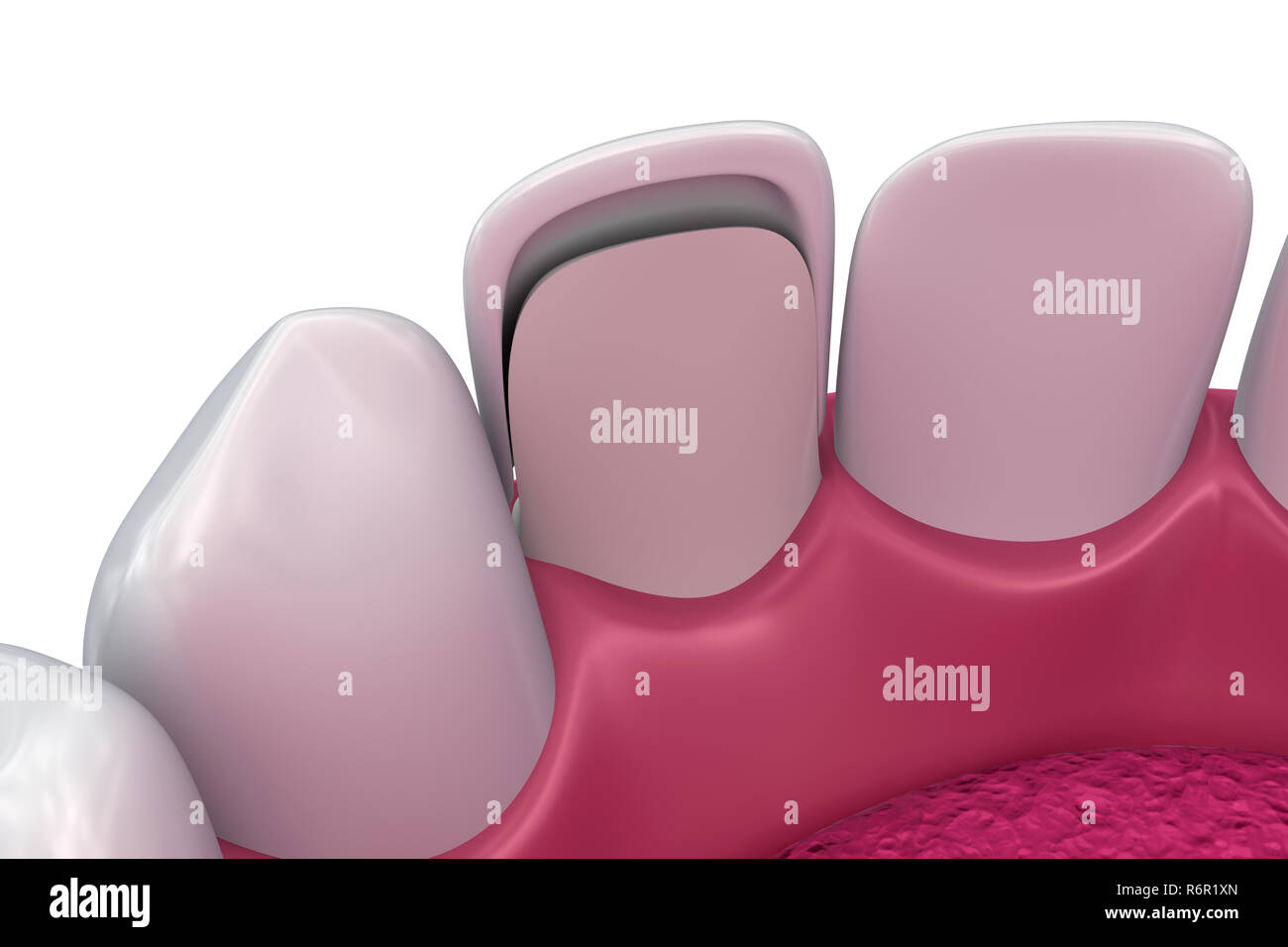 Dental Veneers Porcelain Veneer installation Procedure. 3D