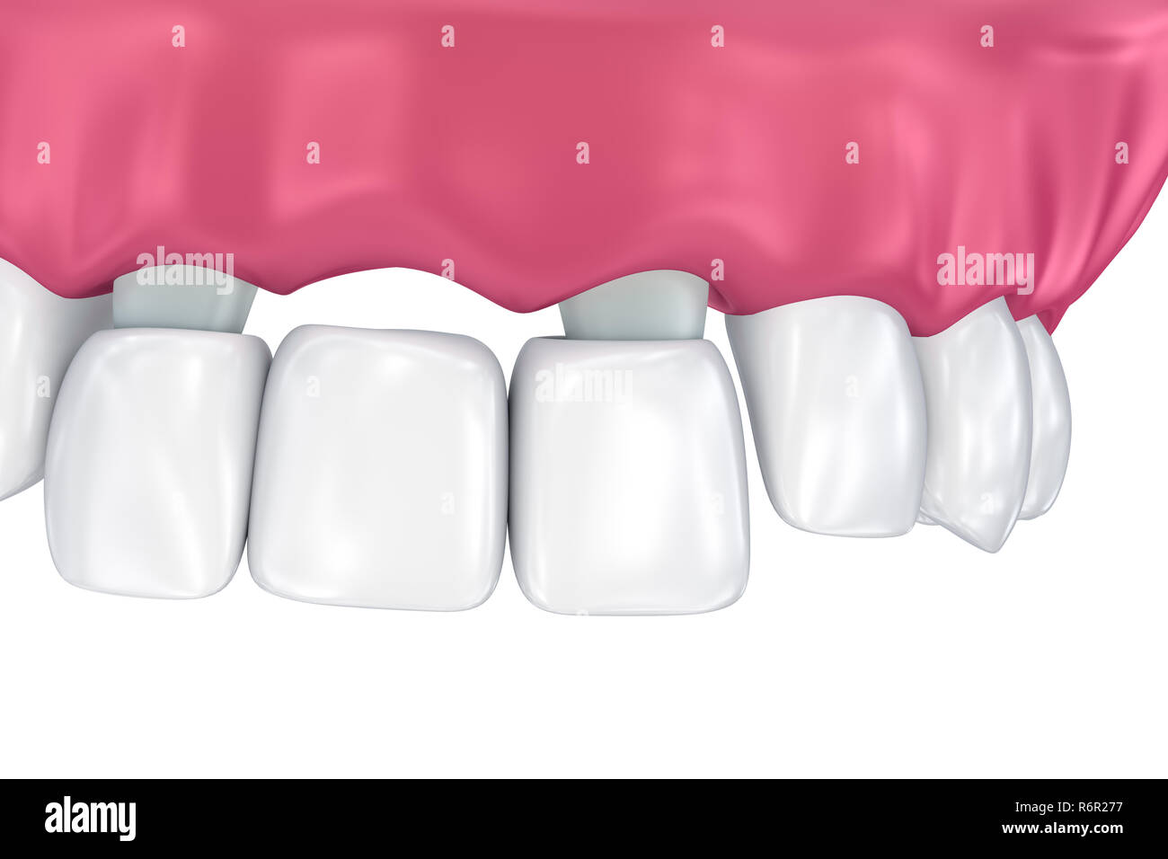 Homemade Temporary Tooth Cement Deep Sale www.oceanproperty.co.th