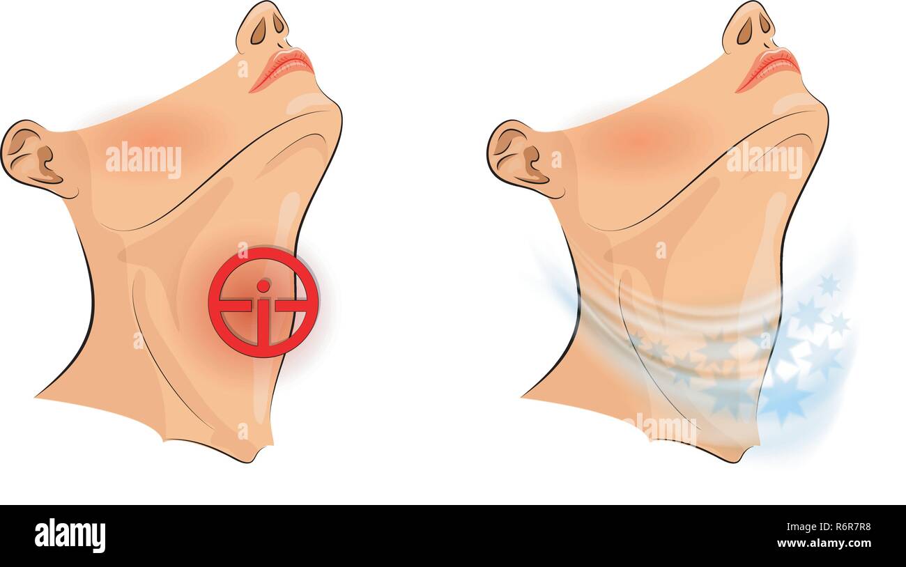 illustration of sore throat. sore throat, pain relief Stock Vector