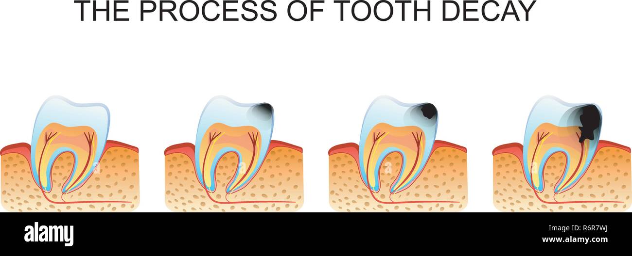 illustration of tooth decay tooth decay Stock Vector