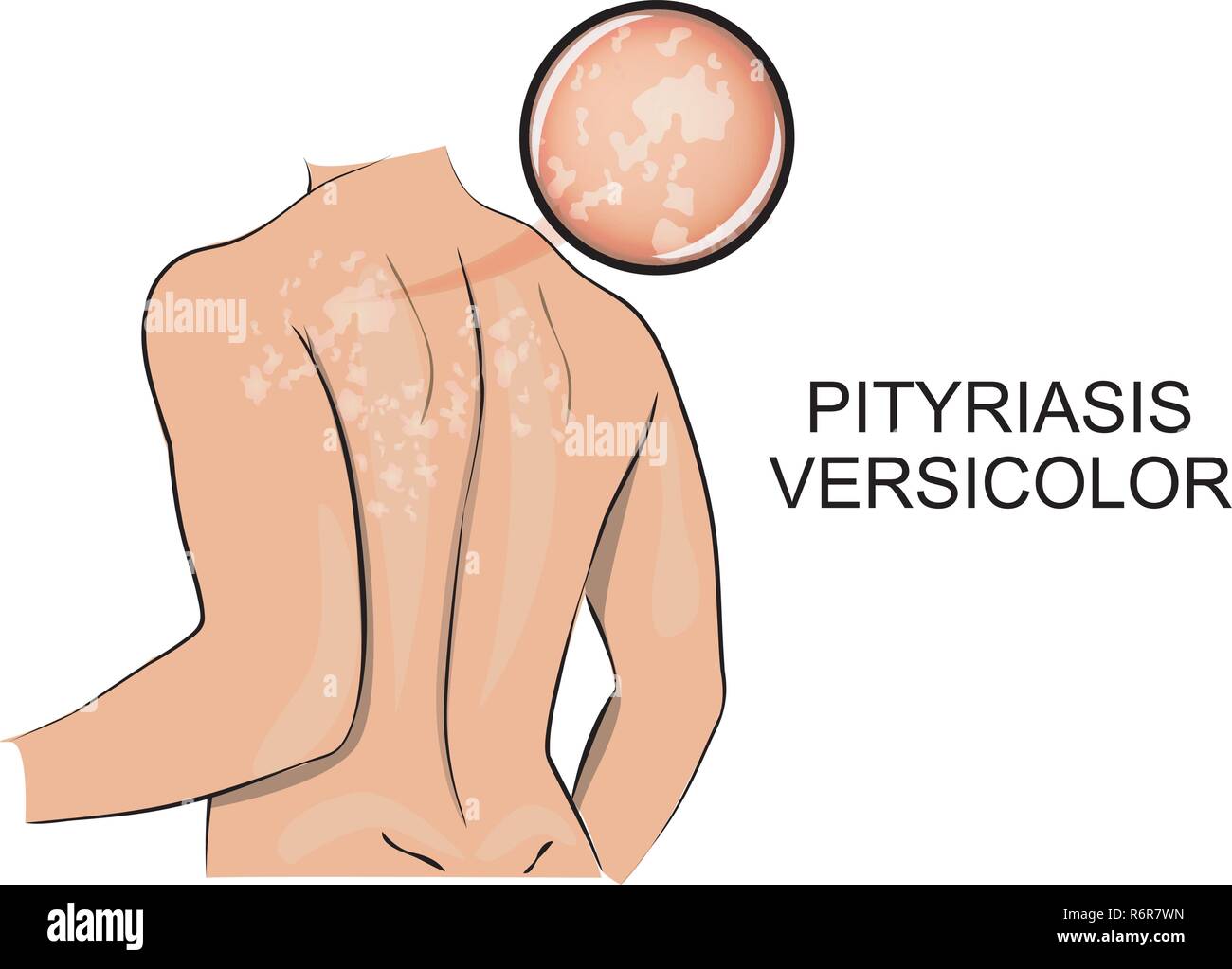 illustration of the back, the affected pityriasis  versicolor. dermatology. Stock Vector