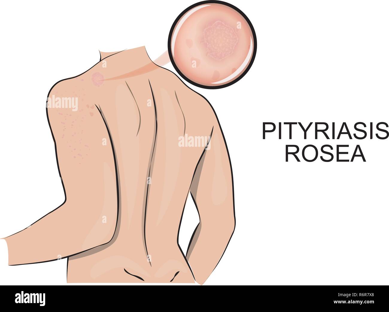illustration of  pityriasis rosea. dermatology. increase under the microscope. Stock Vector