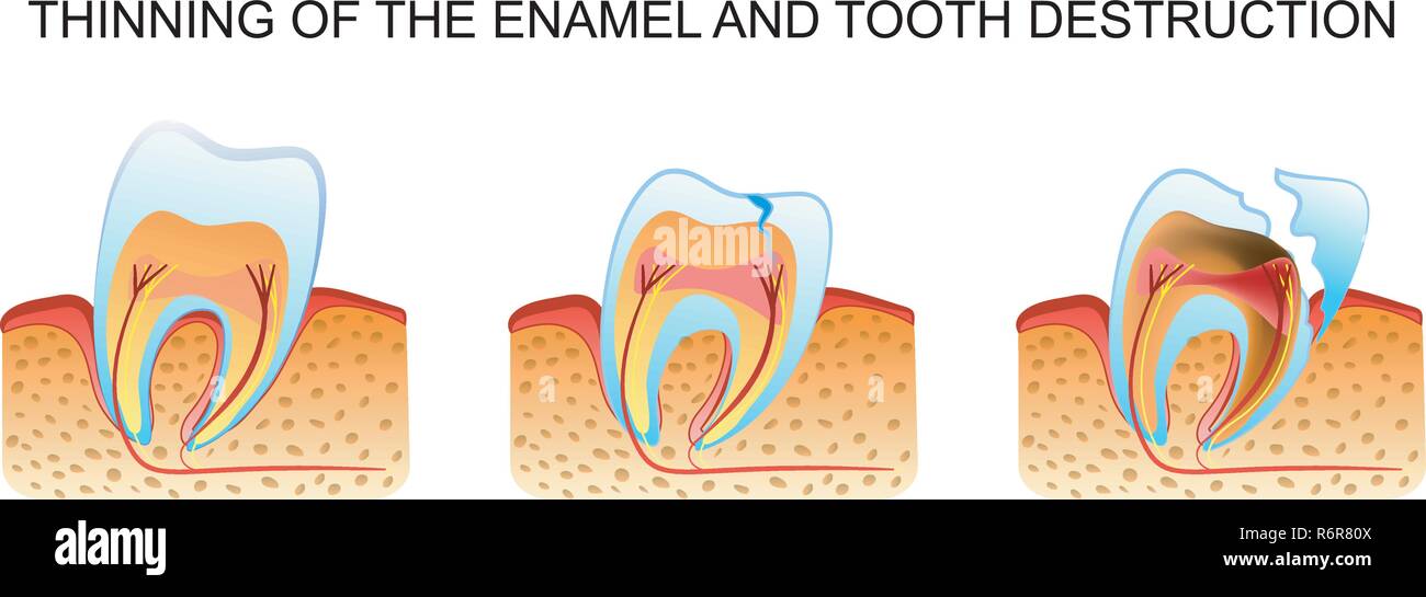 an illustration of the process of thinning of enamel and tooth decay Stock Vector