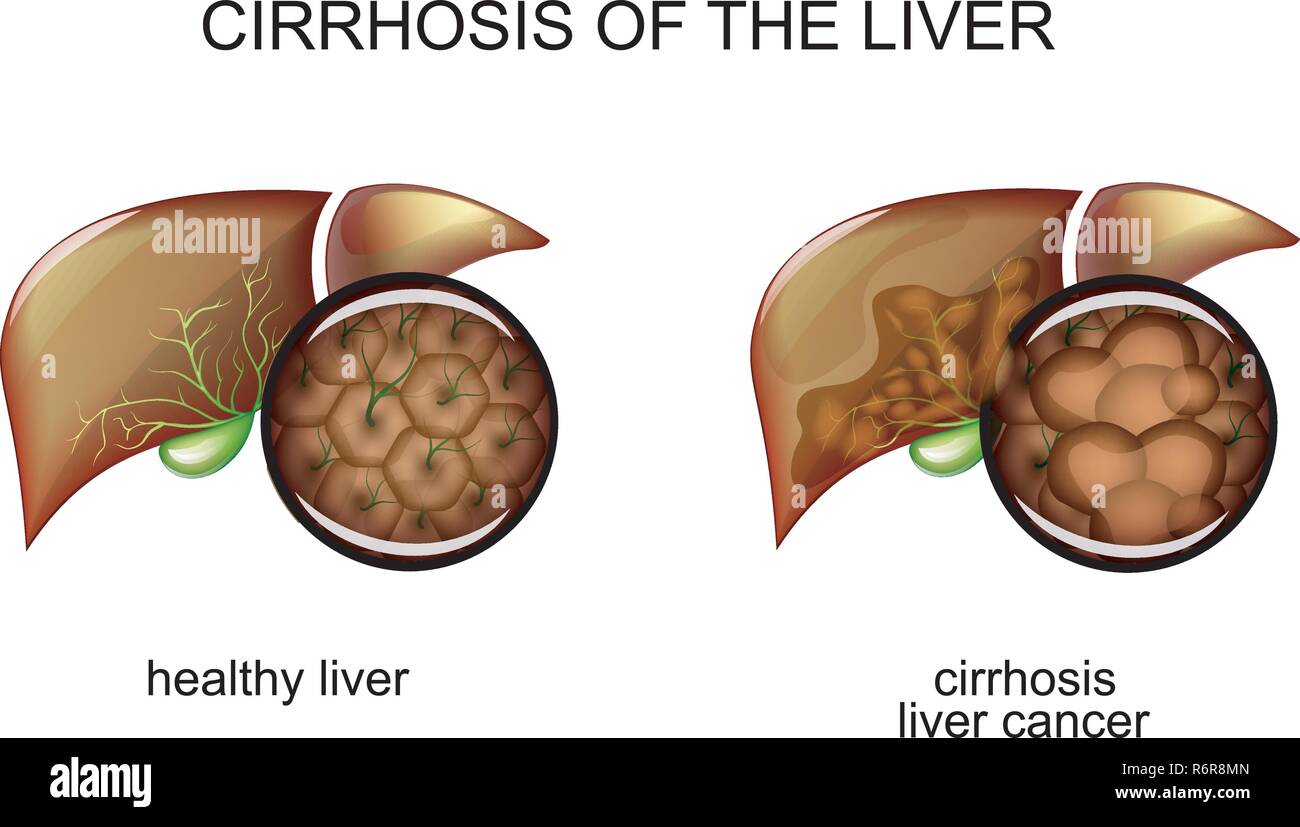 illustration of the liver healthy and the patient with cirrhosis Stock Vector
