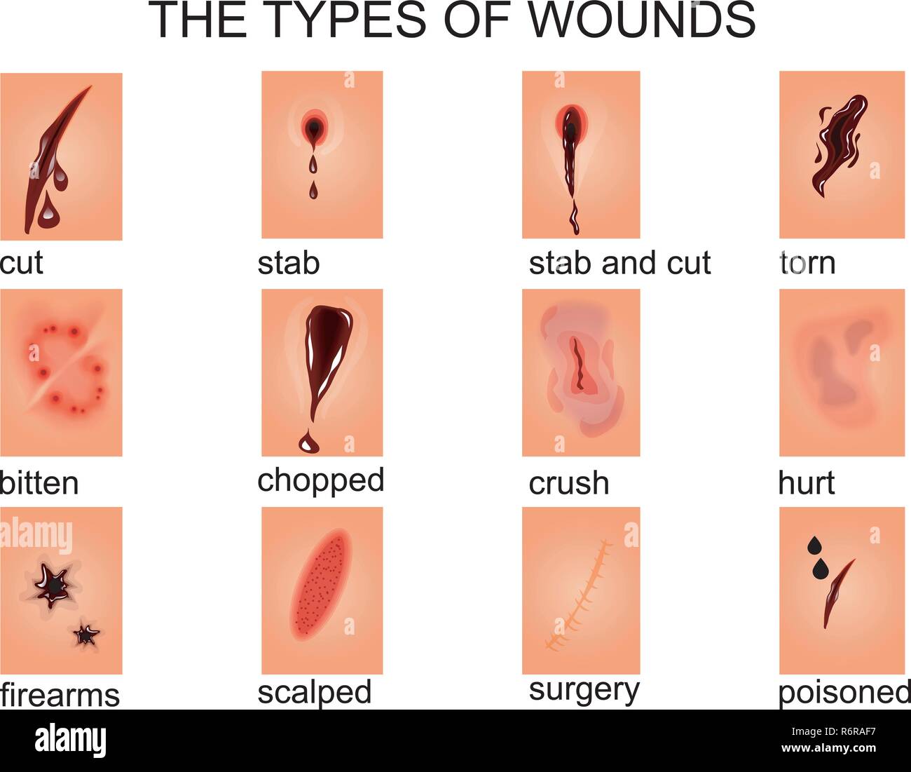 Wound Dressing for Burn Patients | Biotextiles 2014