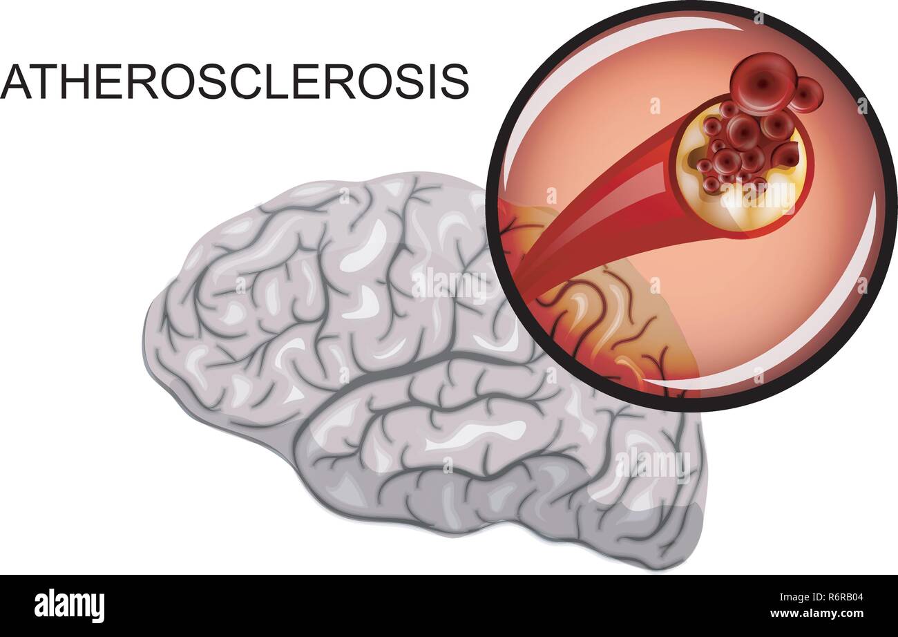 medical vector illustration of blockage of blood vessels of the head  Stock Vector