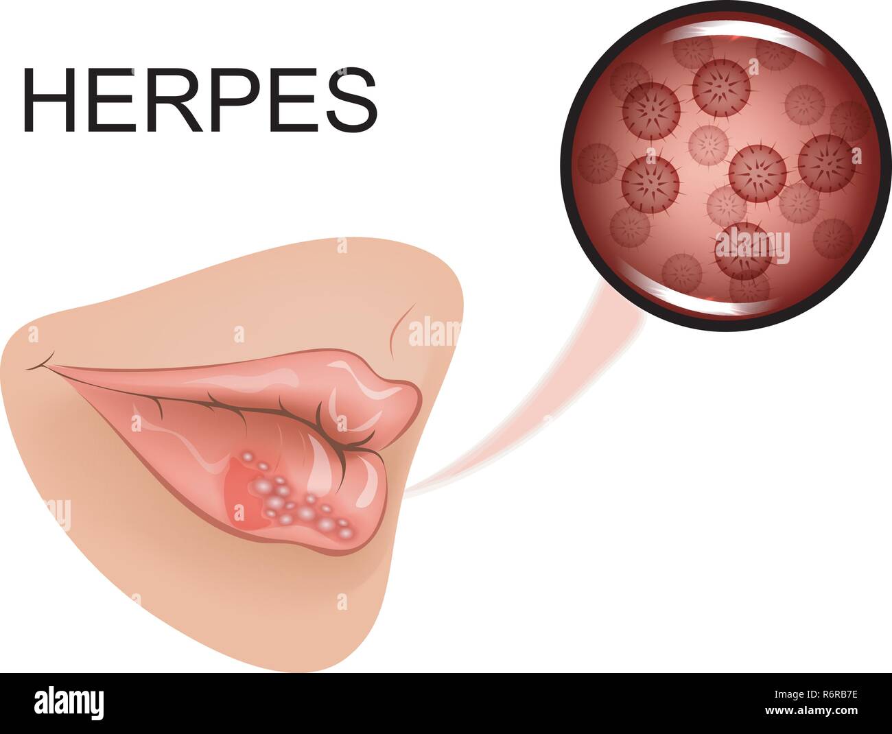 vector illustration of infection on female lips Stock Vector