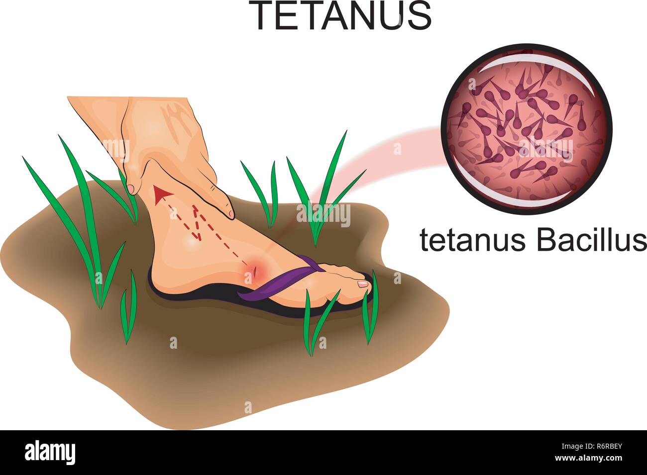 illustration of the foot injury. the risk of tetanus Stock Vector