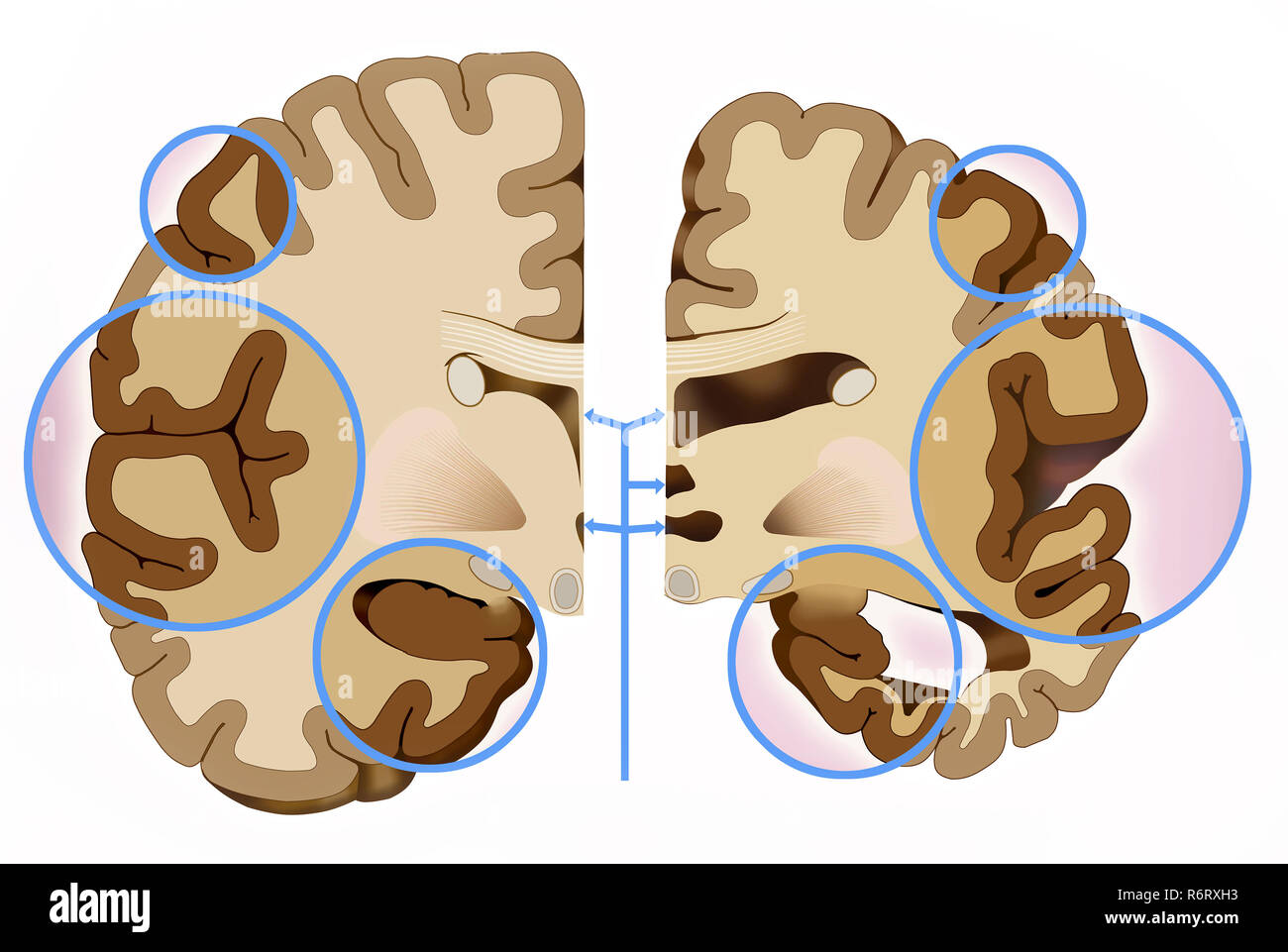 Alzheimer's dementia is a gradual and permanent loss of brain function. It affects memory, thinking, language, judgment, and behavior. Stock Photo