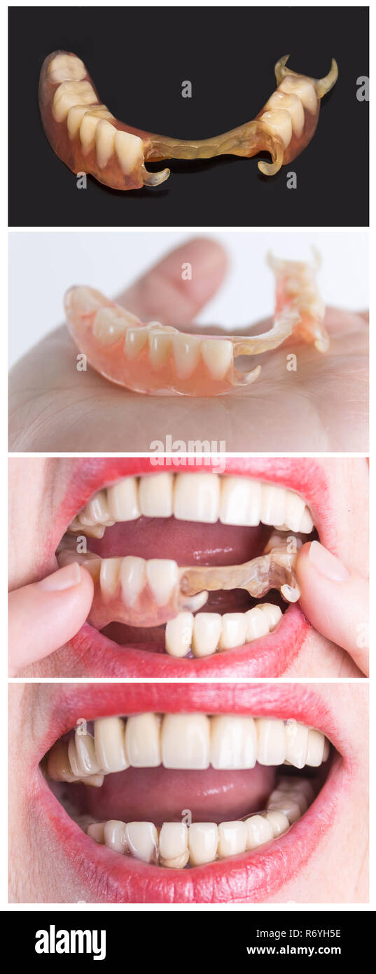 Dental Bridge Before And After