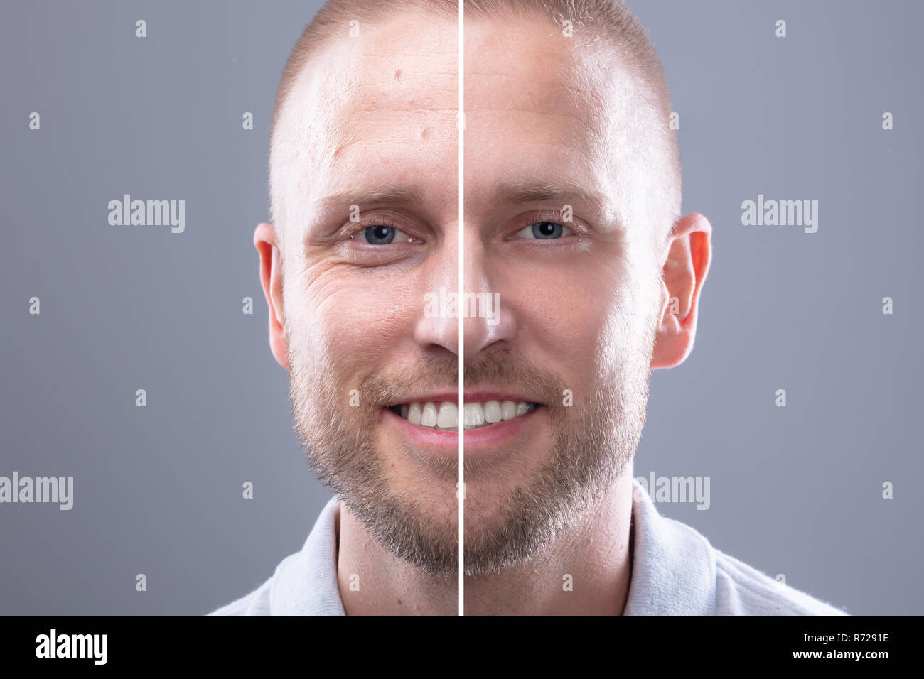 Portrait Of A Smiling Man's Face Before And After Cosmetic Procedure On
