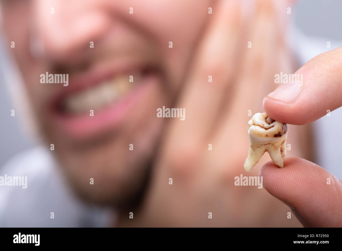 Close-up Of A Man's Hand Holding Decayed Tooth Stock Photo