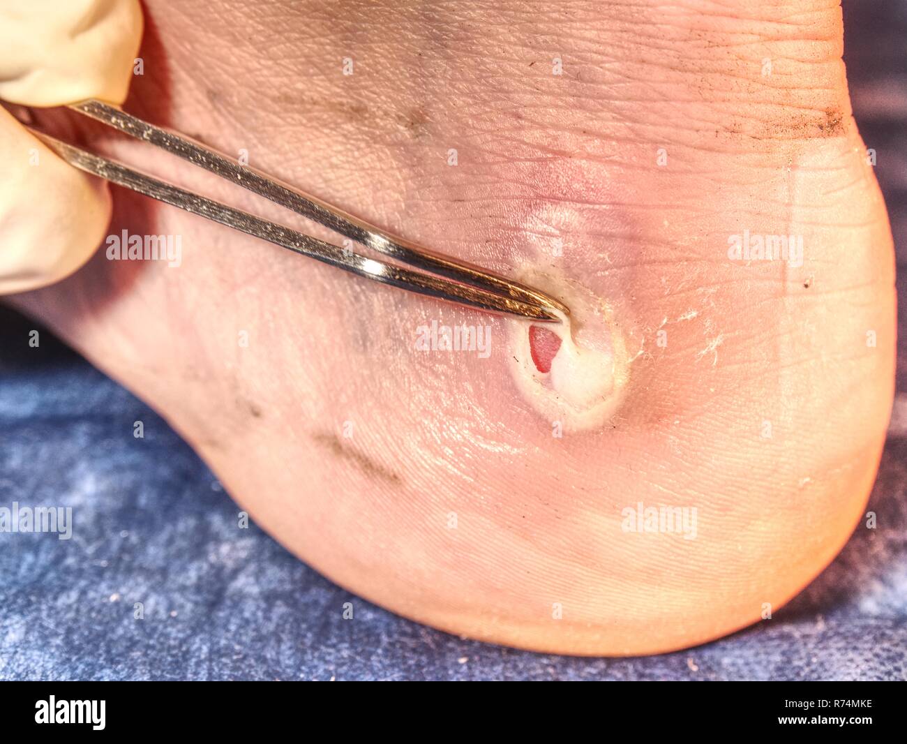Mediciman treat damaged skin on sportsman heel. Nasty hot place of