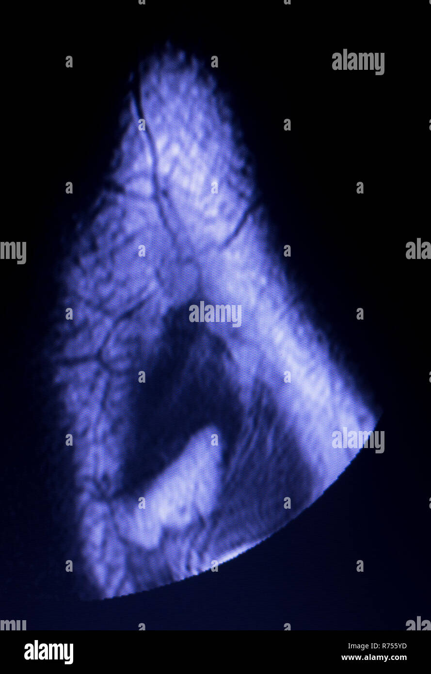 Magnetic resonance imaging MRI knee posterior horn medial meniscus tear ...