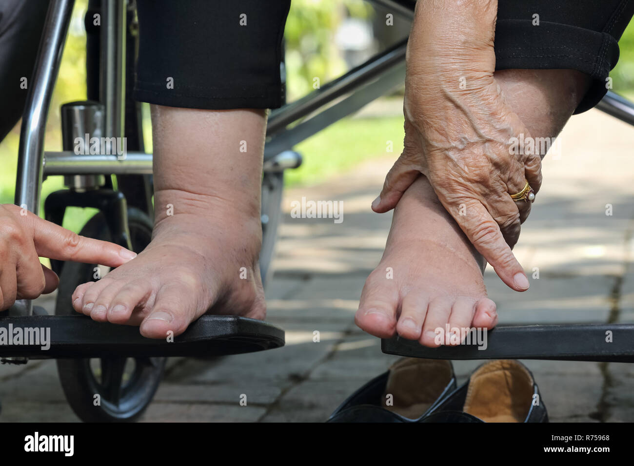 Elderly woman swollen feet press test on wheelchair Stock Photo