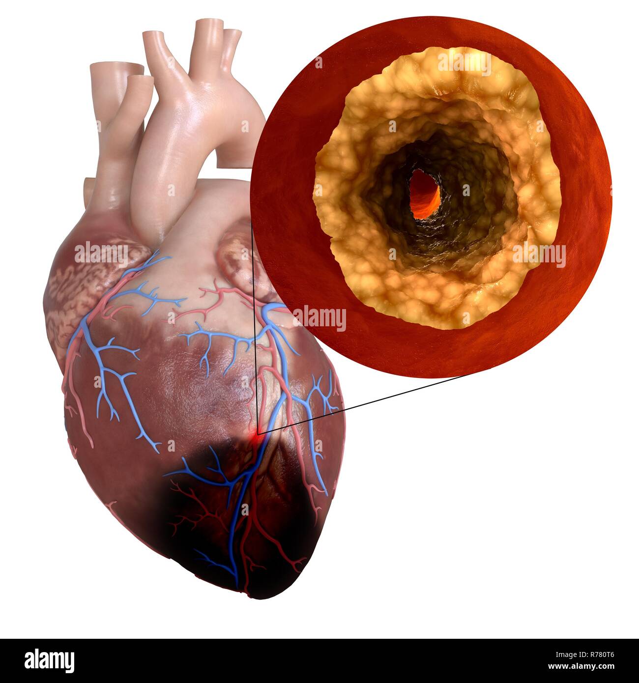 3d rendered illustration of a heart attack Stock Photo - Alamy