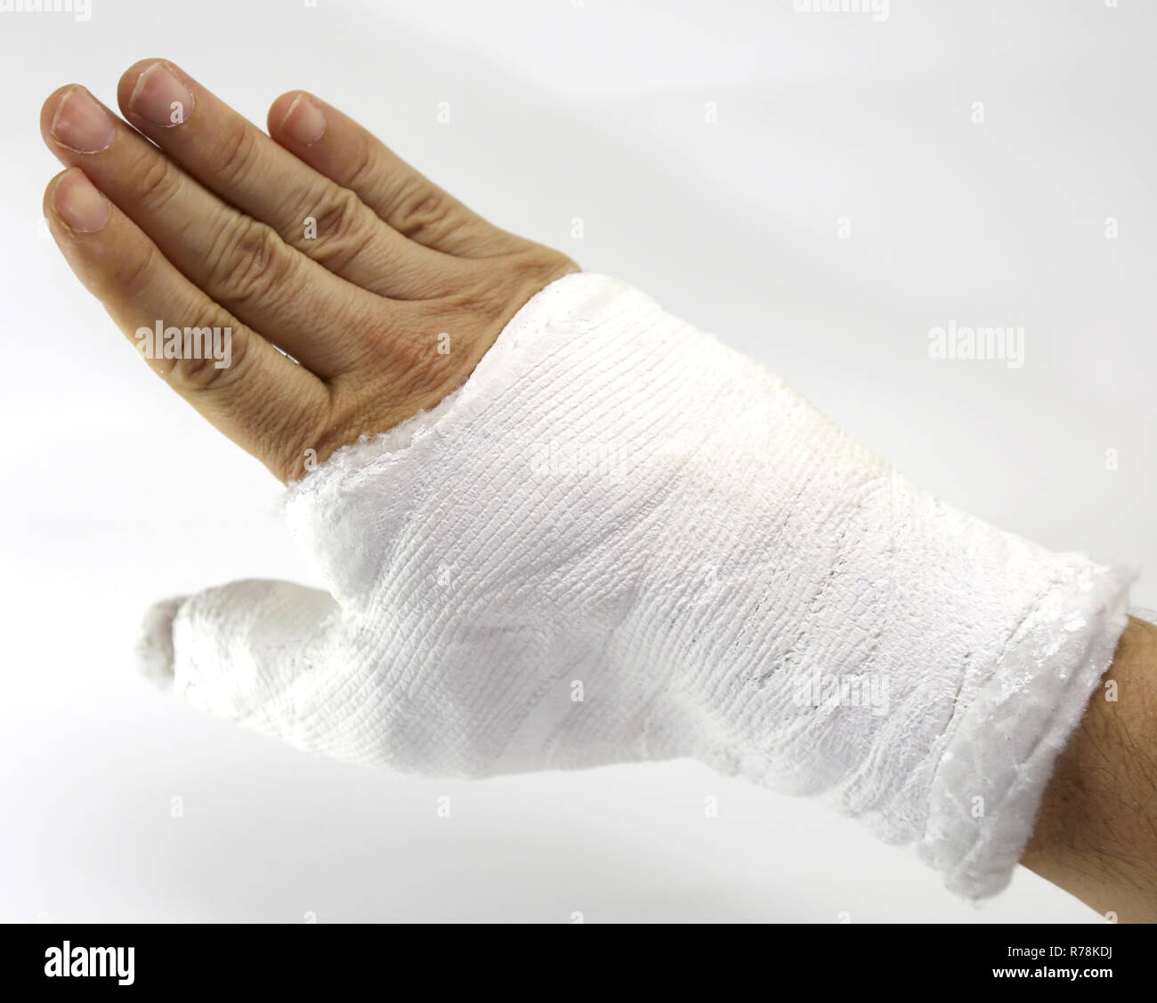 Hand In A Cast First plaster cast hi-res stock photography and images - Alamy