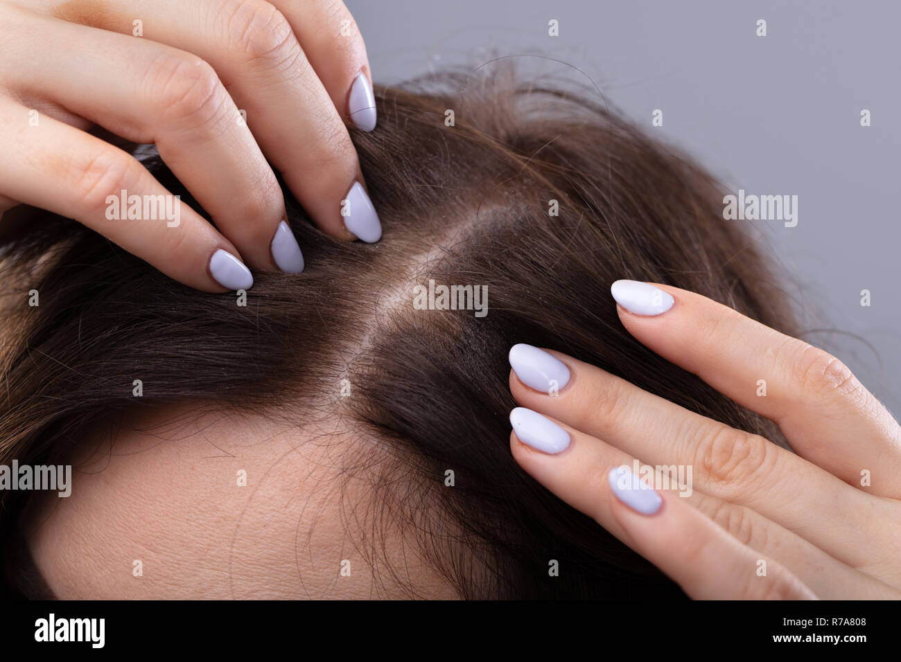Thinning hair woman hi-res stock photography and images - Alamy
