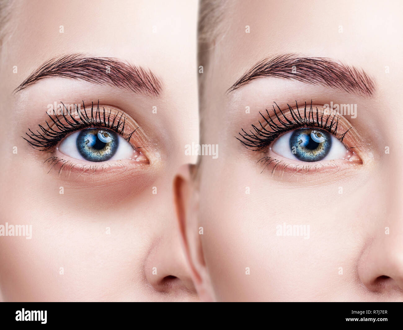 Woman Bruises Face Stock Photos & Woman Bruises Face Stock Images - Alamy