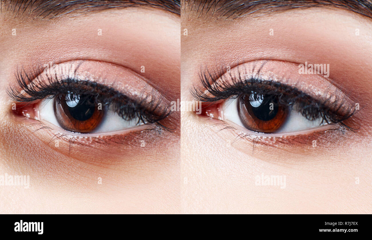 Female eyes with bruises under eyes before and after cosmetic treatment Stock Photo Alamy