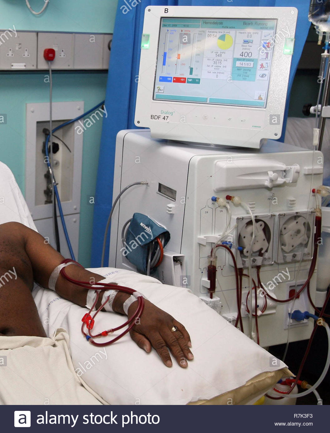 Dialyzer Stock Photos & Dialyzer Stock Images Alamy