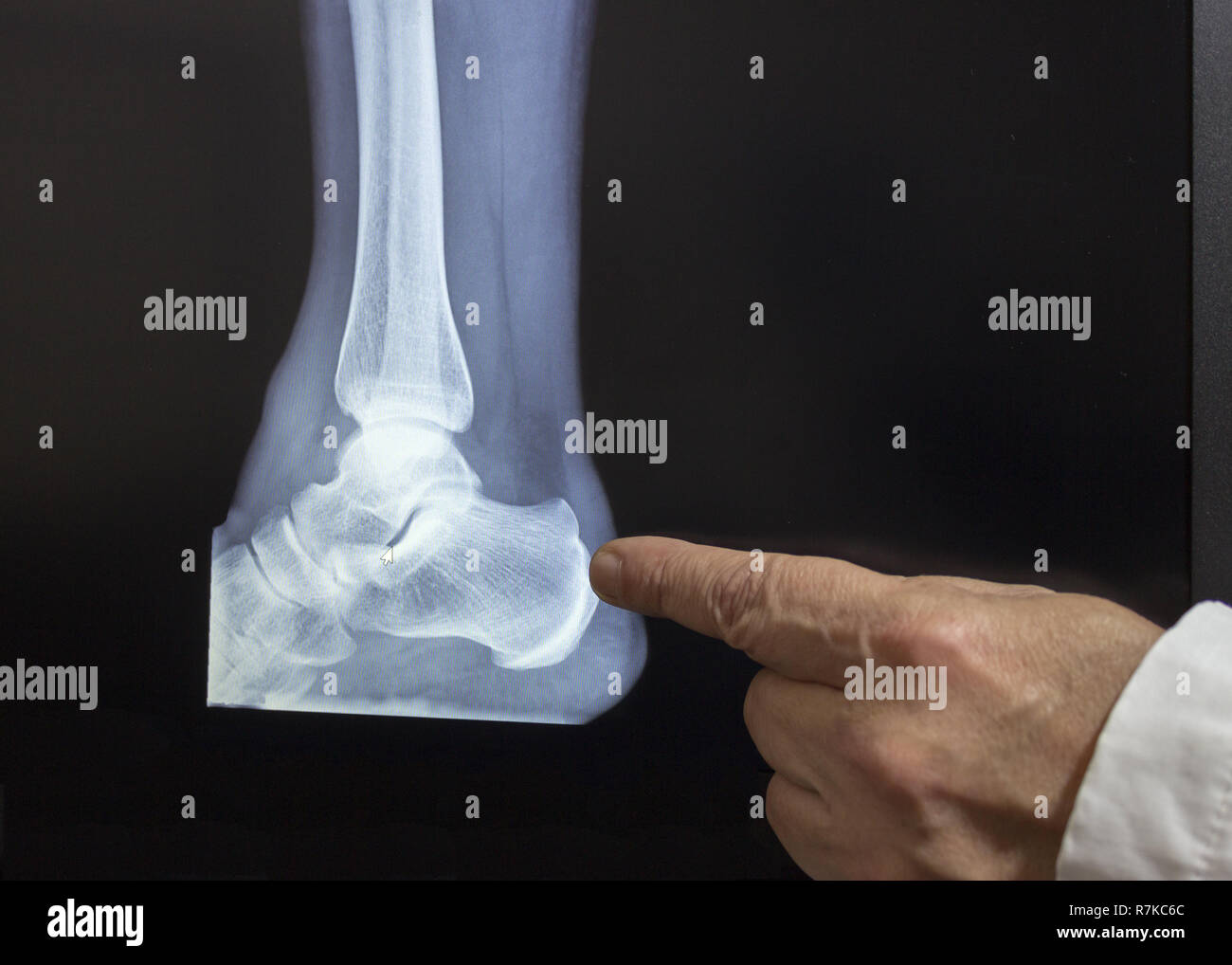 An xray of a heel with a hand of doctor witch pointing to a fracture Stock Photo