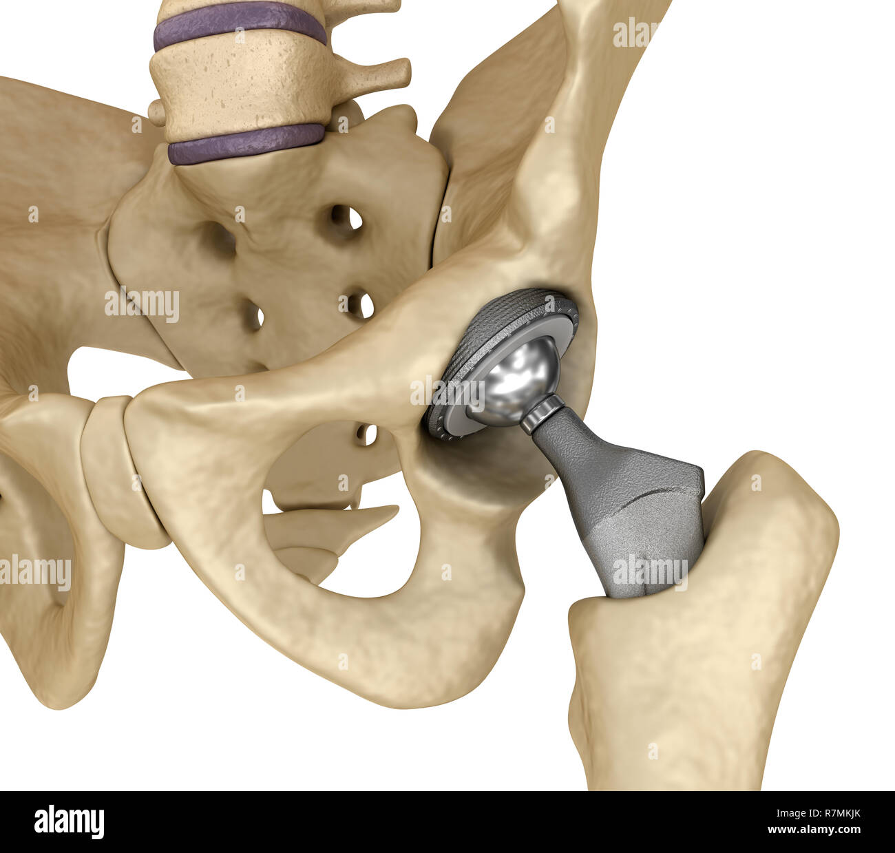 Hip replacement implant installed in the pelvis bone. Medically accurate 3D illustration Stock Photo