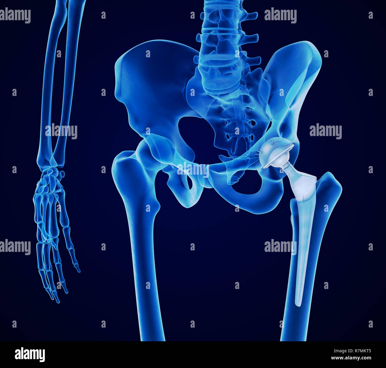 Hip replacement implant installed in the pelvis bone. X-ray view. Medically accurate 3D illustration Stock Photo