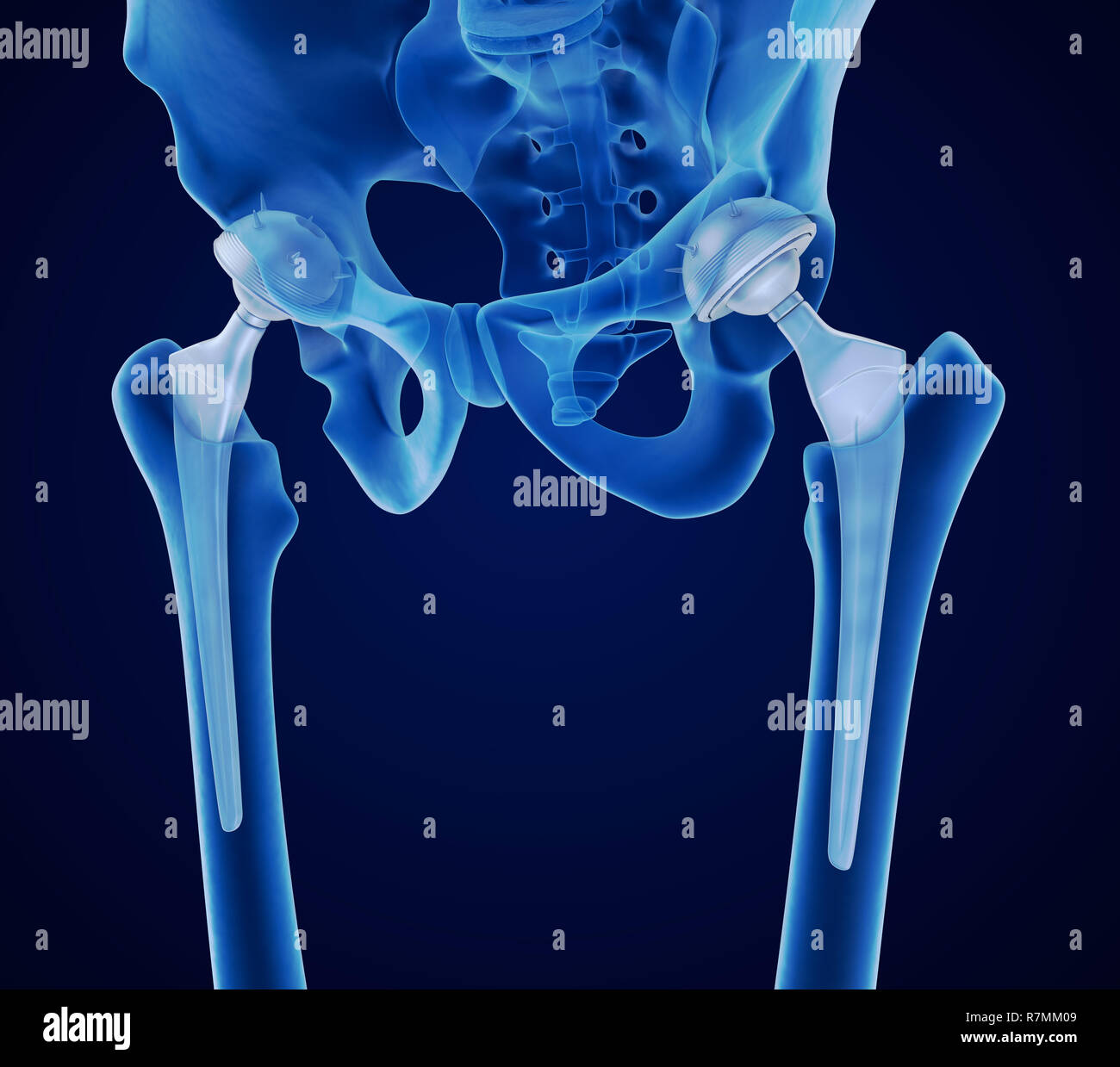 Hip replacement implant installed in the pelvis bone. X-ray view. Medically accurate 3D illustration Stock Photo