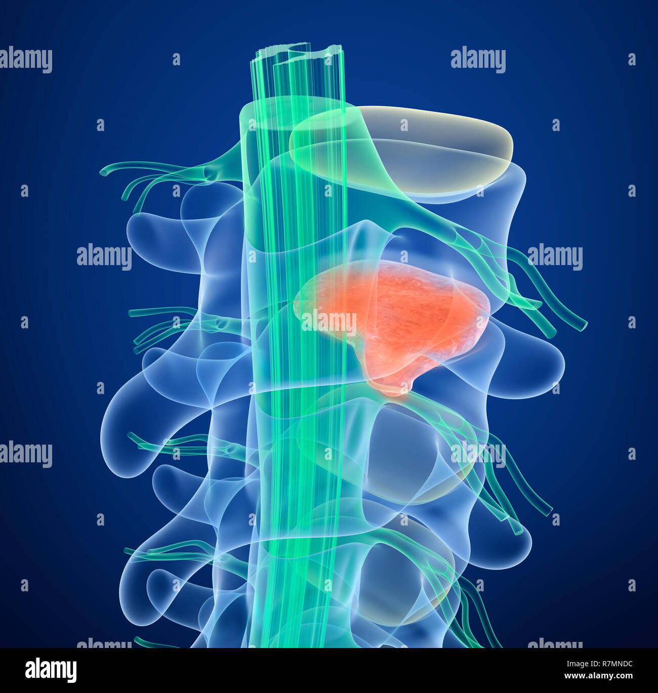 Disc extrusion hi-res stock photography and images - Alamy