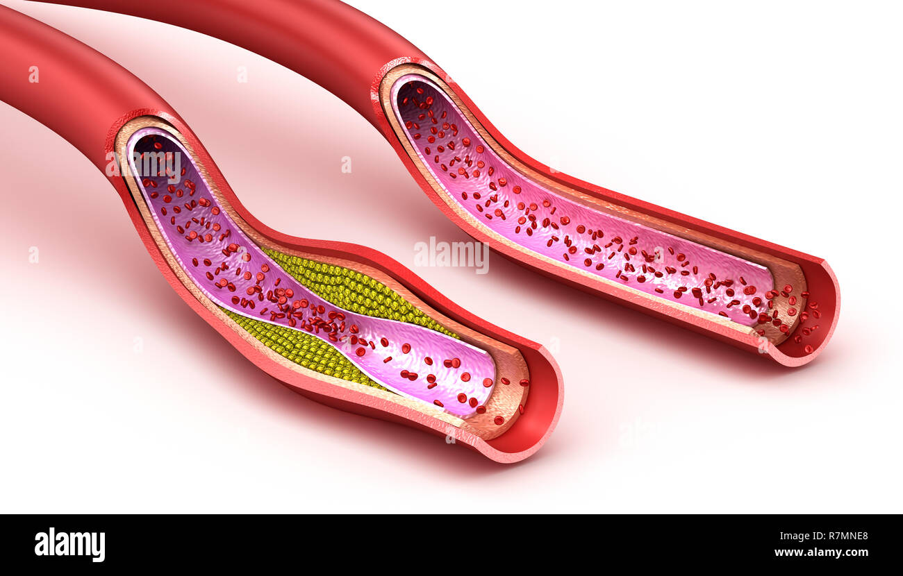 Blood vessel : normal and cholesterol damaged vessel . 3D render Stock Photo