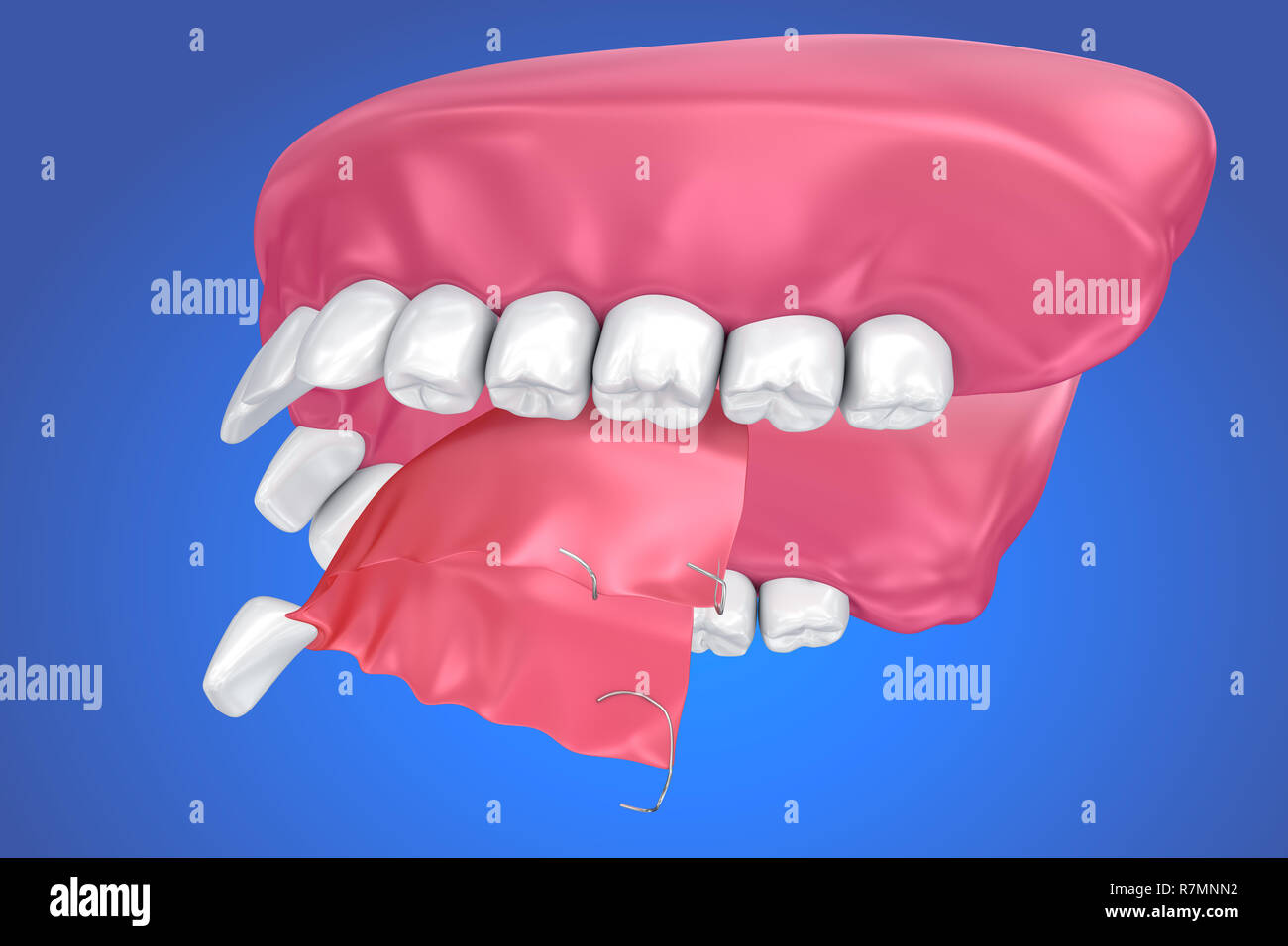 Single Missing Tooth - Removable partial denture .  3D illustration Stock Photo