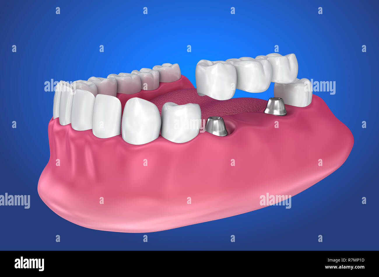 implant supported fixed bridge. Medically accurate 3D illustration