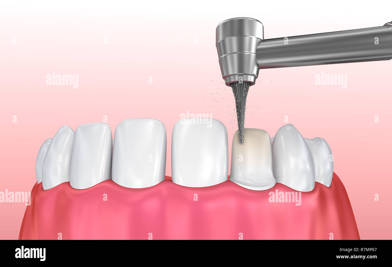 Dental Veneers Porcelain Veneer installation Procedure. 3D