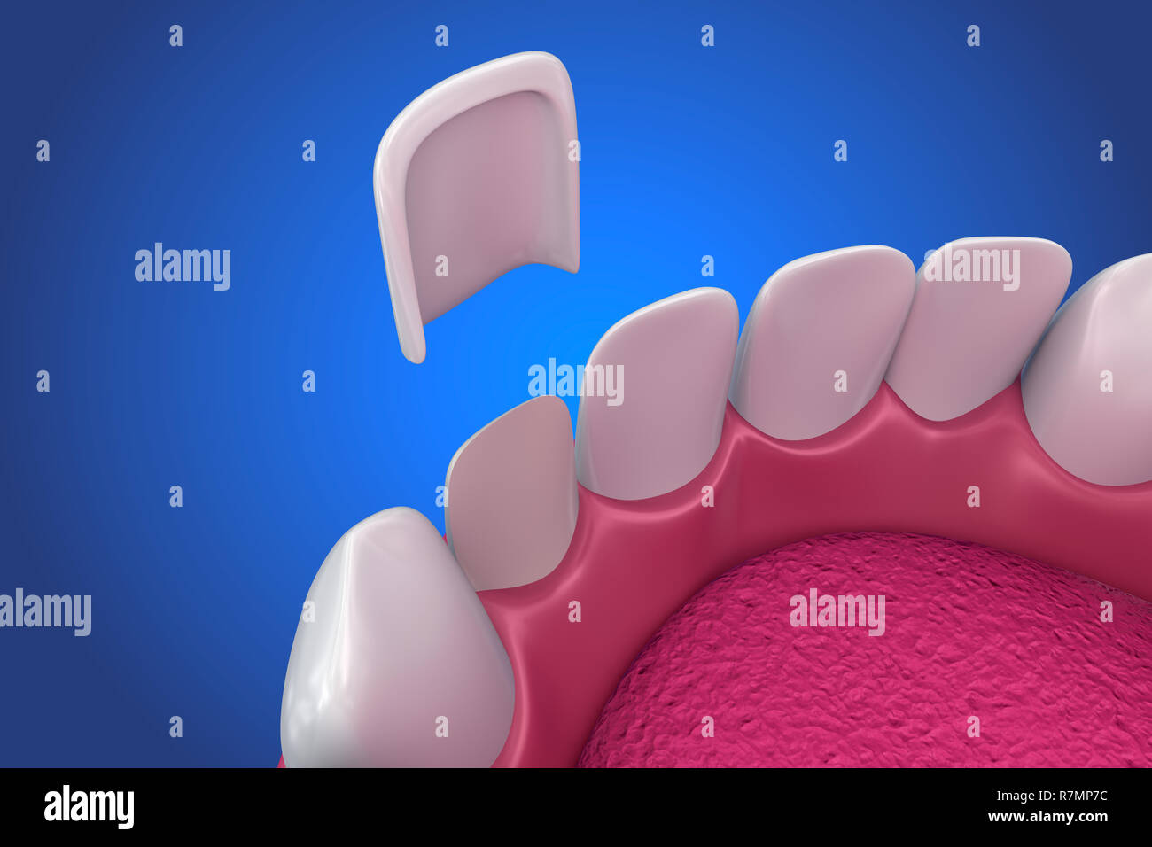 Dental Veneers Porcelain Veneer installation Procedure. 3D