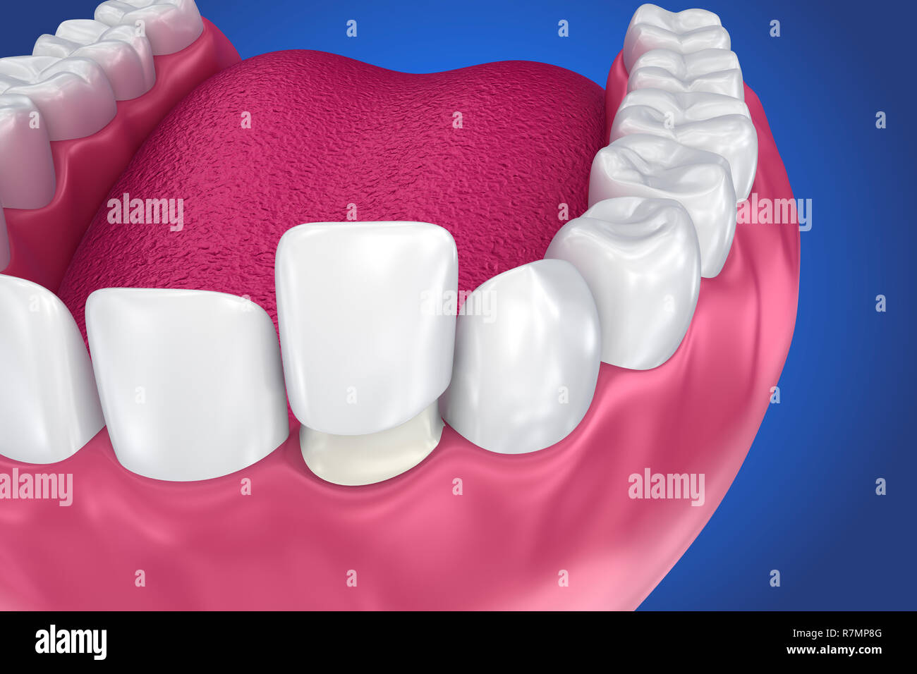Dental Veneers Porcelain Veneer installation Procedure. 3D
