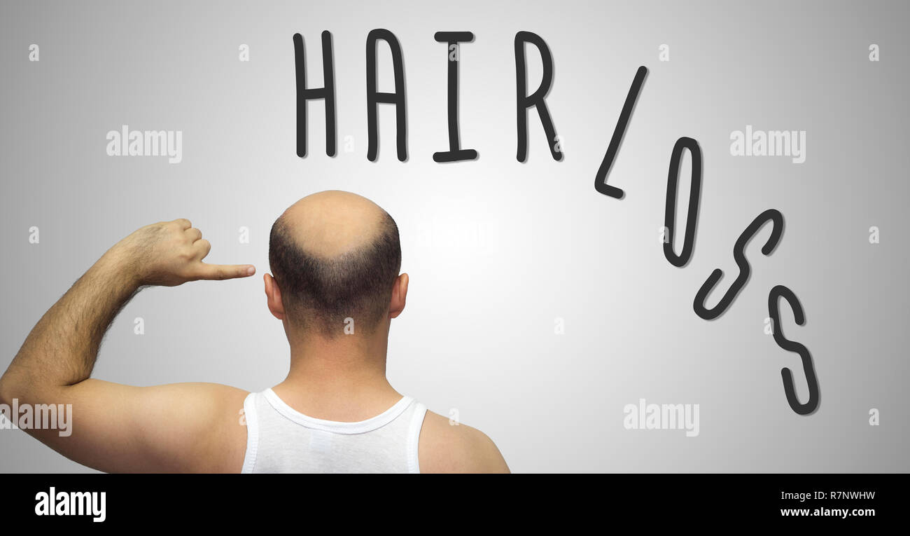 Human hair loss - adult man hand pointing his bald head. Hairloss concept on grey background. Men hair loosing problems. Balding problems of young man Stock Photo