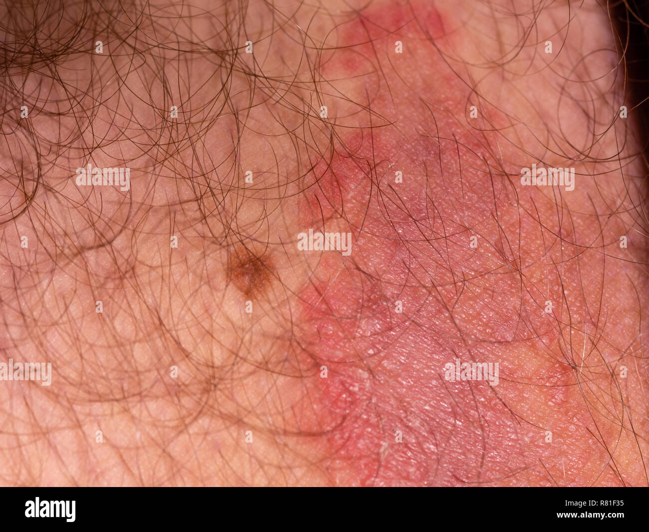 Fungal skin infection on male thigh Stock Photo