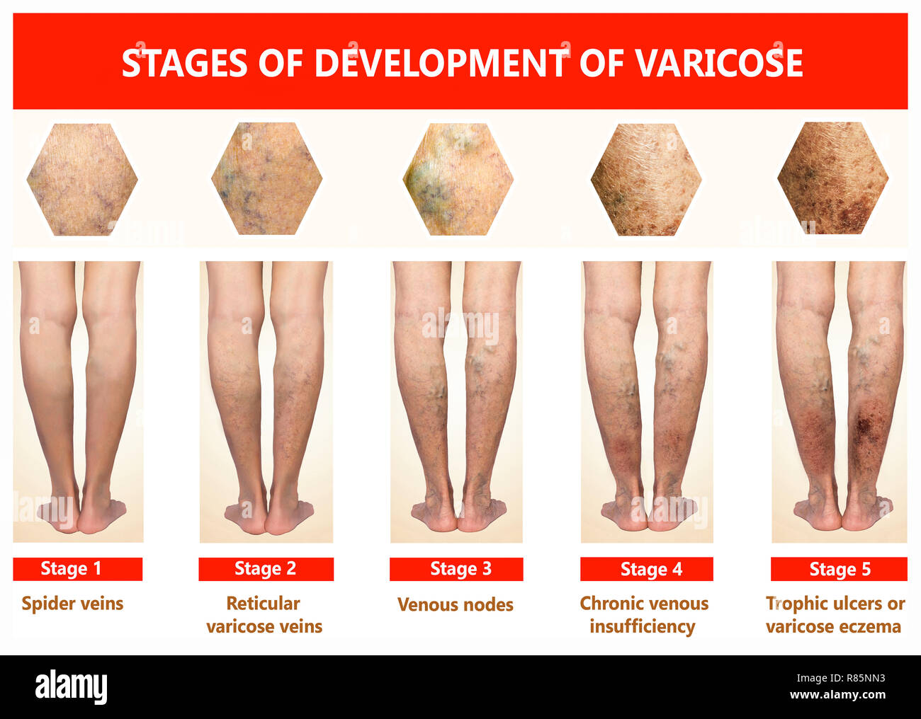 Varicose veins on a female senior leg Stock Photo